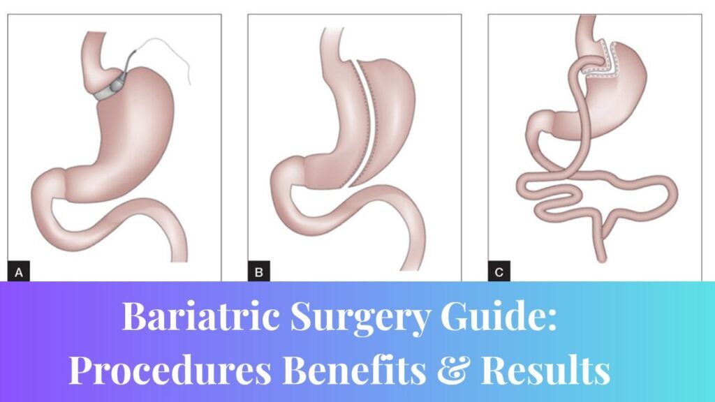 Bariatric Surgery